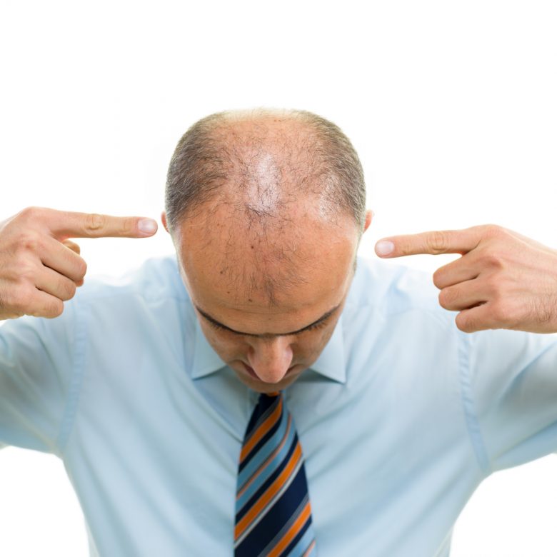 Hair Loss In Baby Boomers